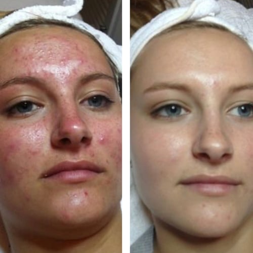 Vorher/Nachher – Hautreinigung