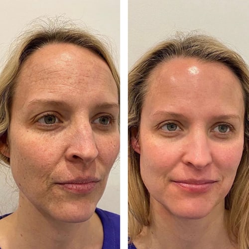 Vorher/Nachher – Anti-Aging