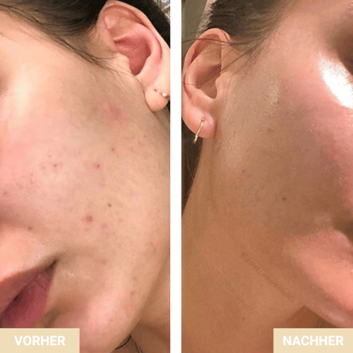 Vorher/Nachher – Unreinheiten