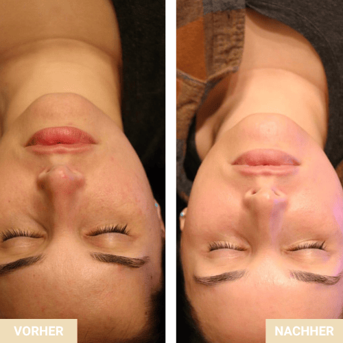 Vorher/Nachher – Hautbild